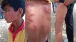 शिक्षकको कुटाइबाट घाइते भएका १३ वर्षीय अविनाश अस्पताल भर्ना 