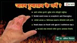 जलन हुनासाथ के गर्ने ? के भन्छन् रिजनल अपरेसन म्यानेजर डा. अनिल धिताल ?