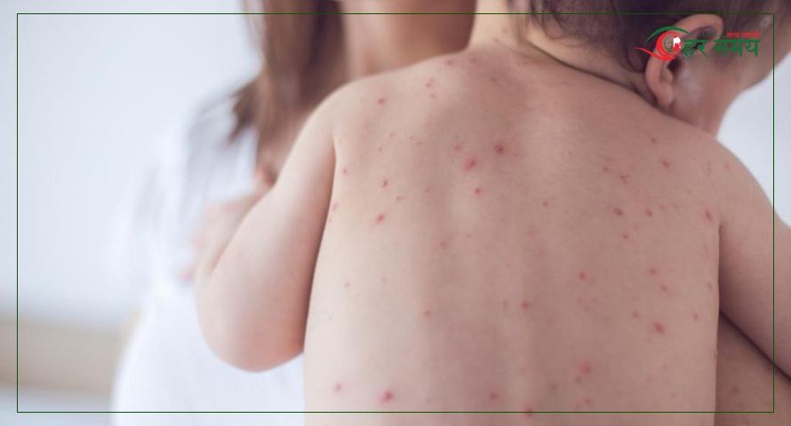 बागलुङको ढोरपाटन नगरपालिकामा फैलिएको दादुरा नियन्त्रणमा