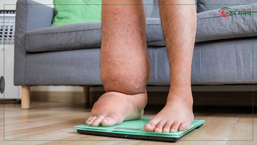 सर्लाहीका १२ पालिकामा फेरि फैलियो हात्तीपाइले, ४ लाखभन्दा बढीलाई औषधि खुवाइँदै