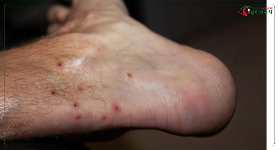 चितवनमा २४६ जनामा स्क्रब टाइफसको सङ्क्रमण, के के हुन्छ लक्षण ?