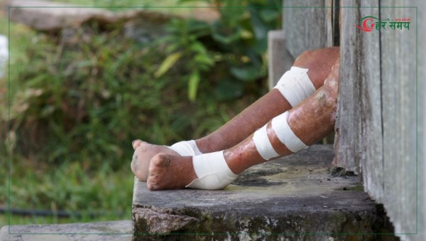 कुष्ठरोग लागेका व्यक्तिसँग झुक्याएर गराइएको विवाह बदर नहुने