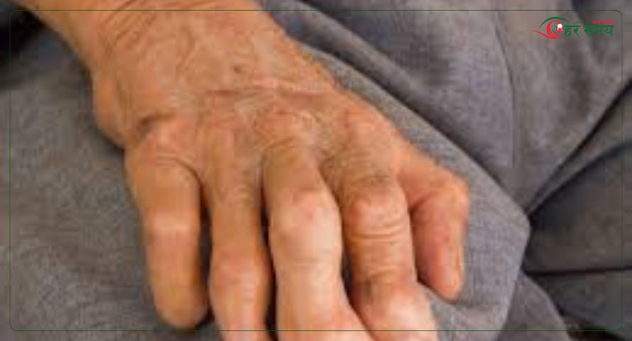 छ महिनाभित्र बाँकेमा ८६ नयाँ कुष्ठरोगी